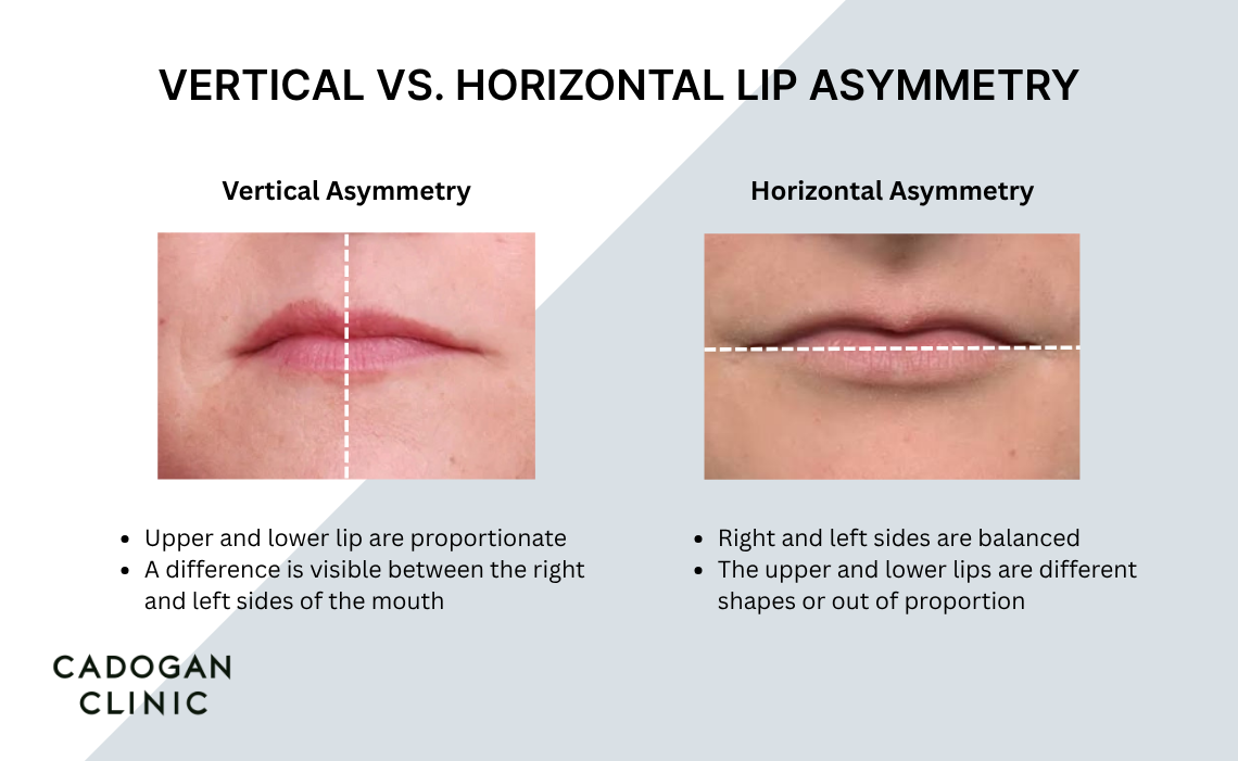 Infographic showing the difference between horizontal and vertial lip asymmetry